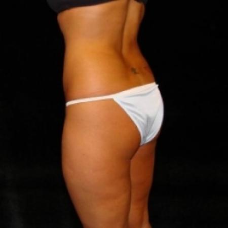 Before image 2 Case #80481 - Buttocks Augmentation Via Fat Grafting with Lipsuction of Abdomen, Waist, Flanks, and Outer Thighs
