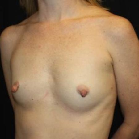 Before image 2 Case #84881 - Breast Augmentation - 40 year old female
