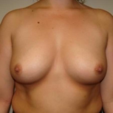 Before image 1 Case #79541 - Breast Augmentation
