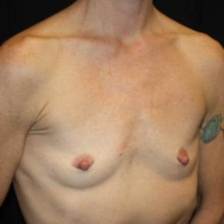 Before image 2 Case #86056 - Breast Augmentation - 40 year old female