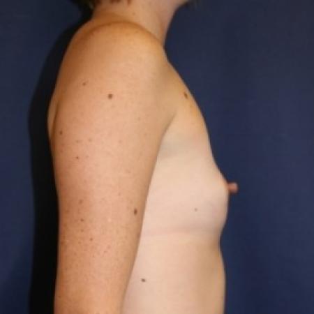 Before image 2 Case #81216 - Breast Augmentation