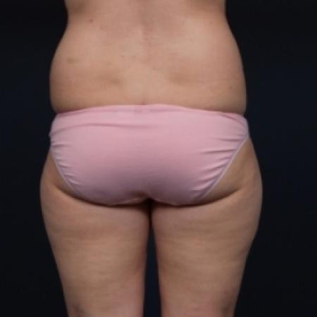 Before image 1 Case #79631 - Liposuction