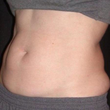 Before image 1 Case #81866 - CoolSculpting