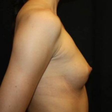 Before image 3 Case #85241 - Breast Augmentation - 24 year old female