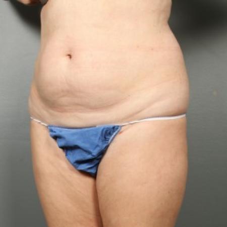 Before image 2 Case #83611 - Liposuction Hips
