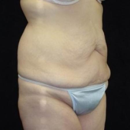 Before image 5 Case #80226 - Circumfrential Abdominoplasty with Liposuction of Abdomen, Waist, and Flanks