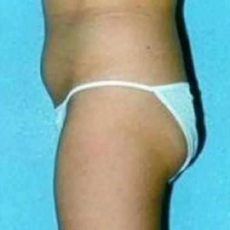 Before image 2 Case #79186 - Liposuction