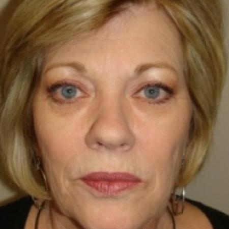 Before image 1 Case #79056 - Facelift