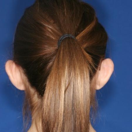 Before image 2 Case #79941 - Otoplasty Ear surgery