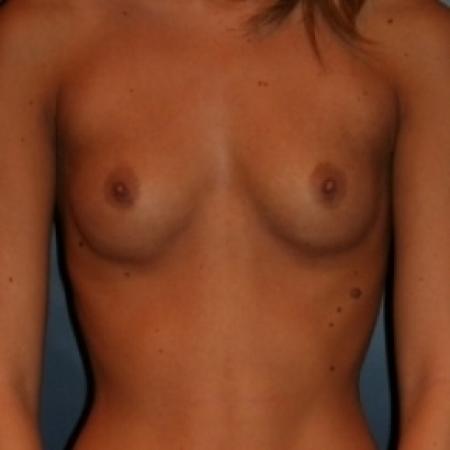 Before image 1 Case #79756 - Proportional Breast Augmentation
