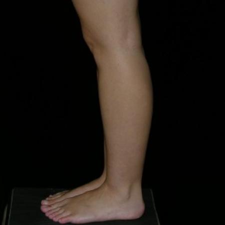 Before image 2 Case #81936 - Calf and Ankle Liposculpture