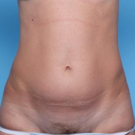 Before image 1 Case #82296 - Abdominoplasty 