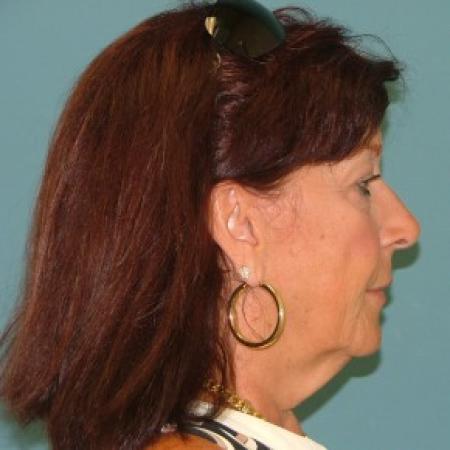 Before image 3 Case #86726 - Facelift+eyelid surgery+forehead lift