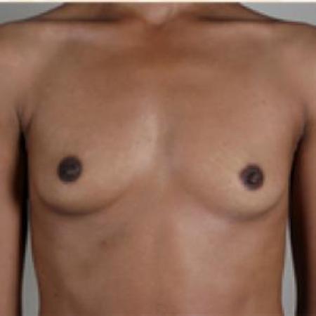 Before image 1 Case #80636 - Breast Augmentation New Jersey