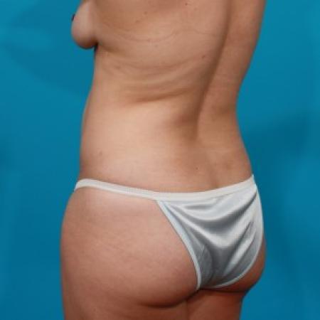 Before image 4 Case #84106 - Abdominoplasty with Flank Lipo