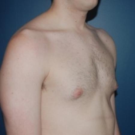 Before image 3 Case #81231 - Bilateral gynecomastia