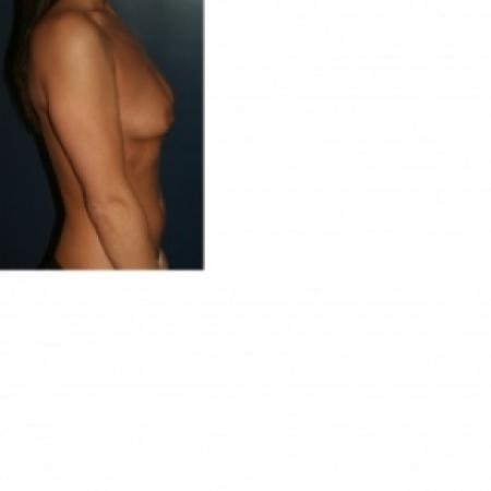 Before image 3 Case #80806 - Natural Proportional Breast Augmentation