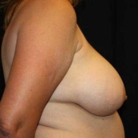 Before image 3 Case #85146 - Breast lift and reduction - 47 year old female
