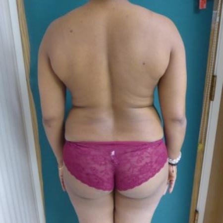 Before image 4 Case #86691 - Body Contouring and Standard Abdominoplasty