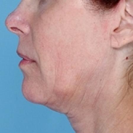 Before image 2 Case #79331 - Non-Surgical Focused Ultrasound