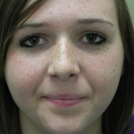Before image 1 Case #81886 - Closed Rhinoplasty