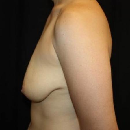 Before image 3 Case #85026 - Breast lift with breast implants - 28 year old female