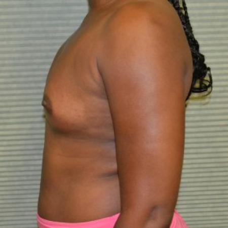 Before image 3 Case #87811 - Breast Augmentation with Mentor MemoryGel smooth round 375cc high profile silicone gel filled breast implants.
