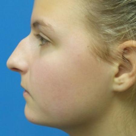 Before image 3 Case #87221 - 18 year old - Rhinoplasty/Septoplasty/Turbinectomy  -  5 months post-op