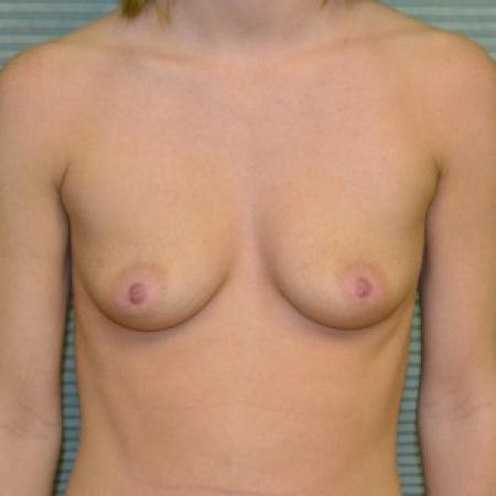 Before image 1 Case #87801 - Breast Augmentation with 350cc Mentor MemoryGel high profile smooth round silicone gel breast implants.