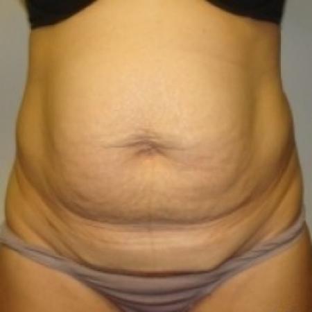 Before image 1 Case #79501 - Tummy Tuck