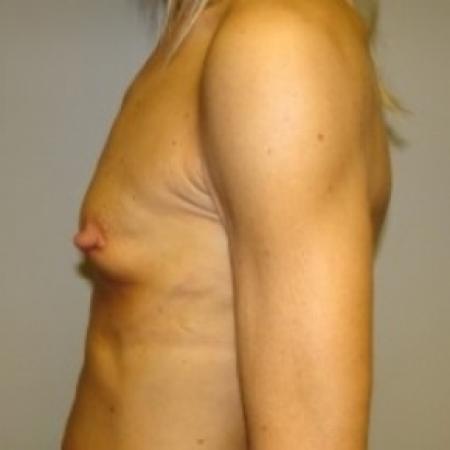 Before image 3 Case #79396 - Breast Augmentation