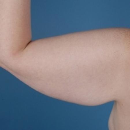 Before image 2 Case #79016 - Arm Lift