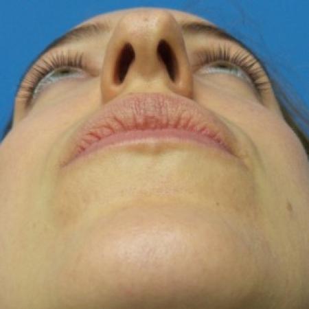 Before image 4 Case #87411 - 31 year-old  -  Open Rhinoplasty/Endoscopic Browlift  -  3 months post-op