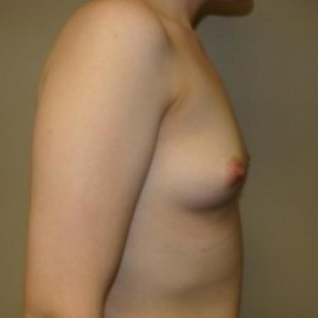Before image 4 Case #79721 - Breast Augmentation