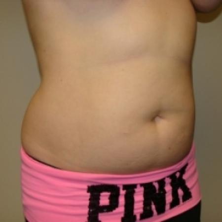 Before image 2 Case #79946 - Liposuction