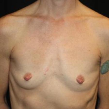 Before image 1 Case #86056 - Breast Augmentation - 40 year old female