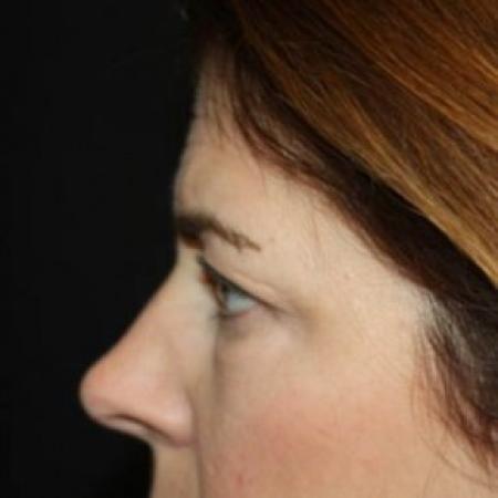 Before image 3 Case #85171 - Blepharoplasty and Browlift - 45 year old female