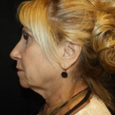 Before image 3 Case #85796 - Face-lift, Brow-lift, Necklift - 68 year old female