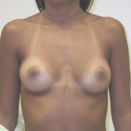 Before image 1 Case #81016 - Breast Augmentation