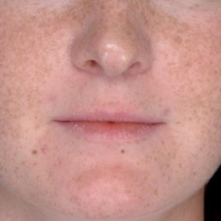 Before image 1 Case #79291 - Injectables