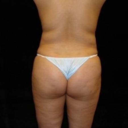 Before image 5 Case #80491 - Buttocks Augmentation Via Fat Grafting with Liposuction of Abdomen, Waist, Flanks, and Dorsal Roll