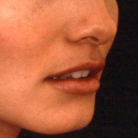 Before Case #81636 - Lip Augmentation
