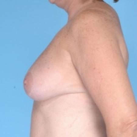 Before image 3 Case #79711 - Bilateral Breast Reduction 