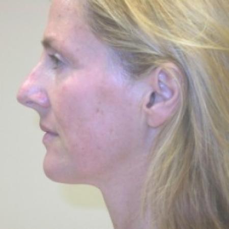 Before image 3 Case #81061 - Facelift and Rhinoplasty