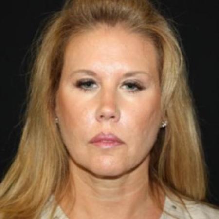 Before image 1 Case #85286 - Facelift and Neck Lift - 54 year old female
