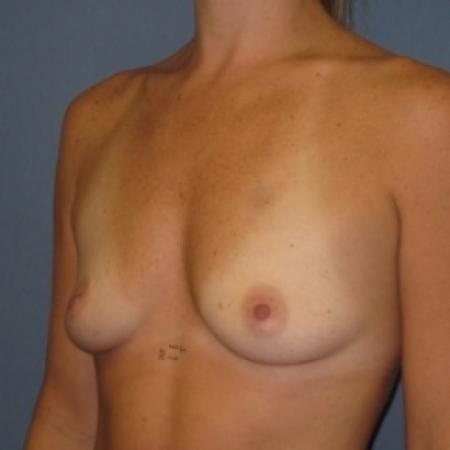 Before image 2 Case #80701 - Breast Augmentation