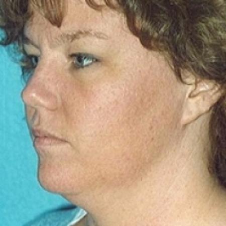 Before image 3 Case #79196 - Liposuction