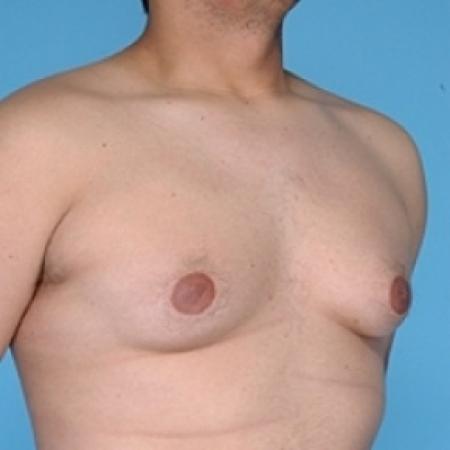 Before image 3 Case #79236 - Male Breast Reduction