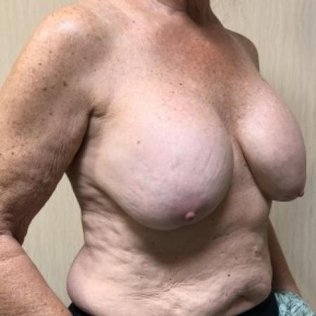 Before image 2 Case #87281 - Breast Augmentation Revision