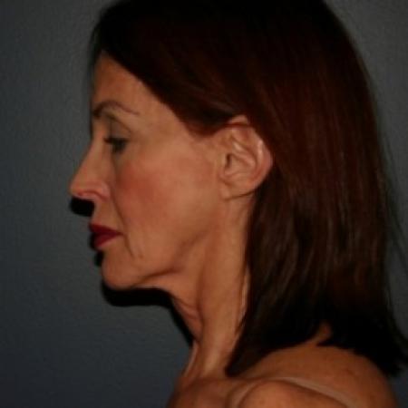 Before image 3 Case #81031 - Facelift